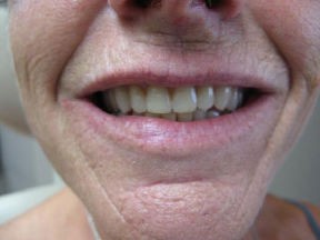 Denture after Correcting Smiles