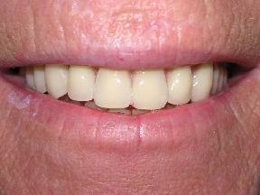 denture after Ceating More Natural Smiles