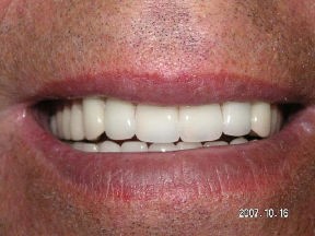 denture after Improving Your Smile