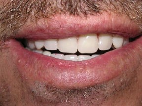 denture after Transforming Your Smile