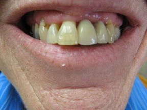 denture before Correcting Smiles