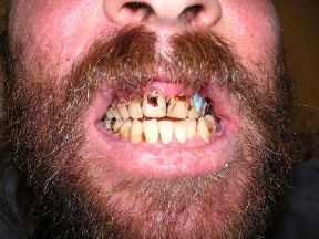 denture before Transforming Your Smile
