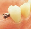 Precision-attchment-for-partial-denture