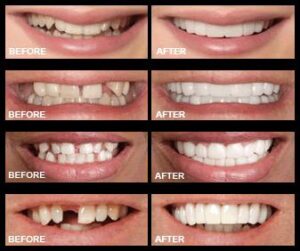 snap-on-smile-before-after